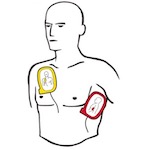 Svartvit skissad bild på en man som har två elektroder i gult och rött på bröstet. 